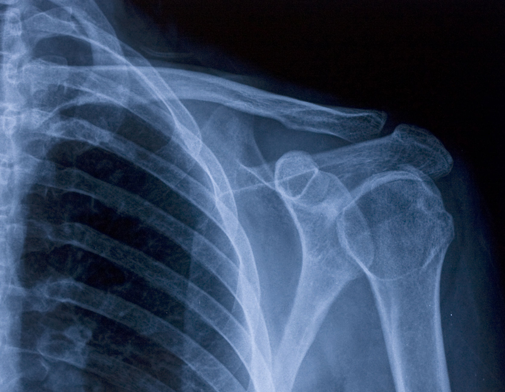 X-Ray Film Silver Recovery